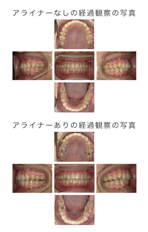 アライナーあり、なし経過観察