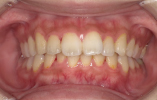 予防歯科症例