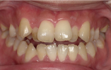 予防歯科症例