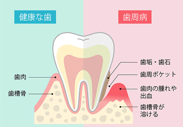 歯周病予防