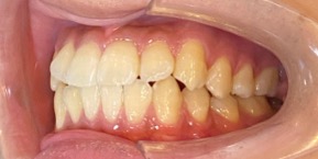 インビザライン症例ビフォア3