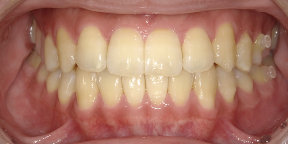 インビザライン症例アフター2
