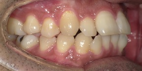 インビザライン症例ビフォア1