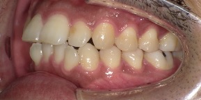 インビザライン症例ビフォア3