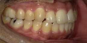インビザライン症例アフター1