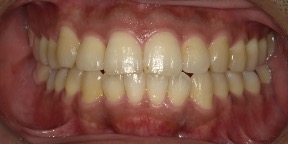 インビザライン症例アフター2