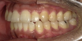 インビザライン症例アフター3