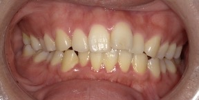 インビザライン症例ビフォア2