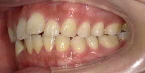 インビザライン症例ビフォア3