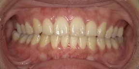 インビザライン症例アフター2