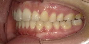 インビザライン症例アフター3