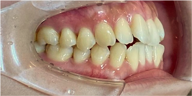 インビザライン症例ビフォア1