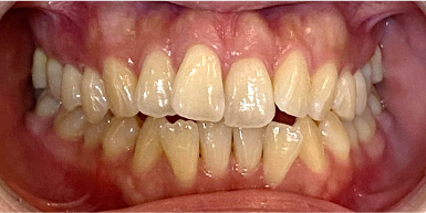 インビザライン症例ビフォア2