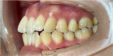 インビザライン症例ビフォア3