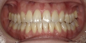 インビザライン症例アフター2