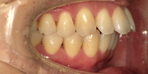 インビザライン症例ビフォア1