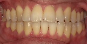 インビザライン症例ビフォア2