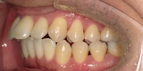 インビザライン症例ビフォア3