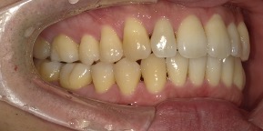 インビザライン症例アフター1