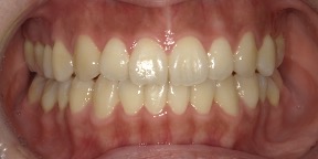 インビザライン症例アフター2