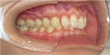 インビザライン症例ビフォア1