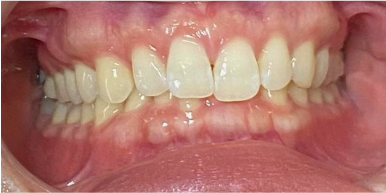 インビザライン症例ビフォア2