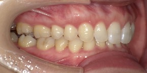 インビザライン症例アフター1