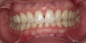 インビザライン症例アフター2