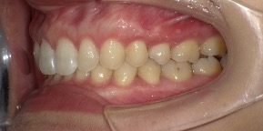 インビザライン症例アフター3
