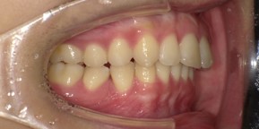 インビザライン症例アフター1