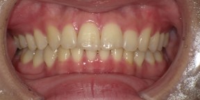 インビザライン症例アフター2