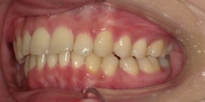 インビザライン症例アフター3