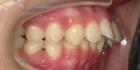 インビザライン症例ビフォア1