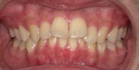 インビザライン症例ビフォア2