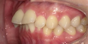 インビザライン症例ビフォア3