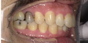 インビザライン症例アフター1