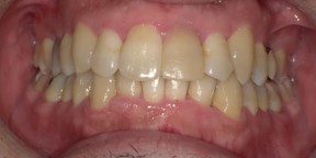 インビザライン症例アフター2