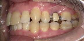インビザライン症例アフター3