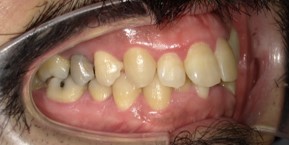 インビザライン症例ビフォア1