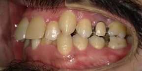 インビザライン症例ビフォア3