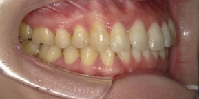 インビザライン症例アフター1