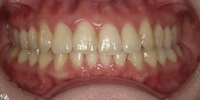 インビザライン症例アフター2