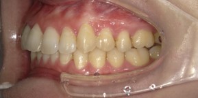 インビザライン症例アフター3