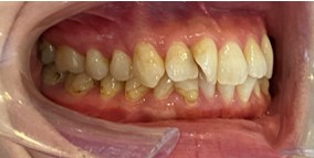 インビザライン症例ビフォア1