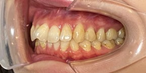 インビザライン症例ビフォア3