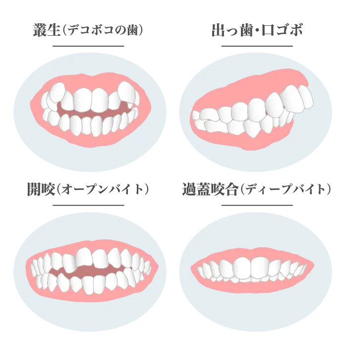 矯正した方が良い歯の種類