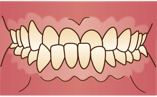 下顎前突（かがくぜんとつ）・受け口