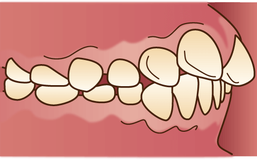 上顎前突（じょうがくぜんとつ）・出っ歯