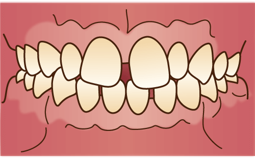 空隙歯列（くうげきしれつ）・すきっ歯