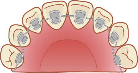 裏側矯正（舌側矯正）